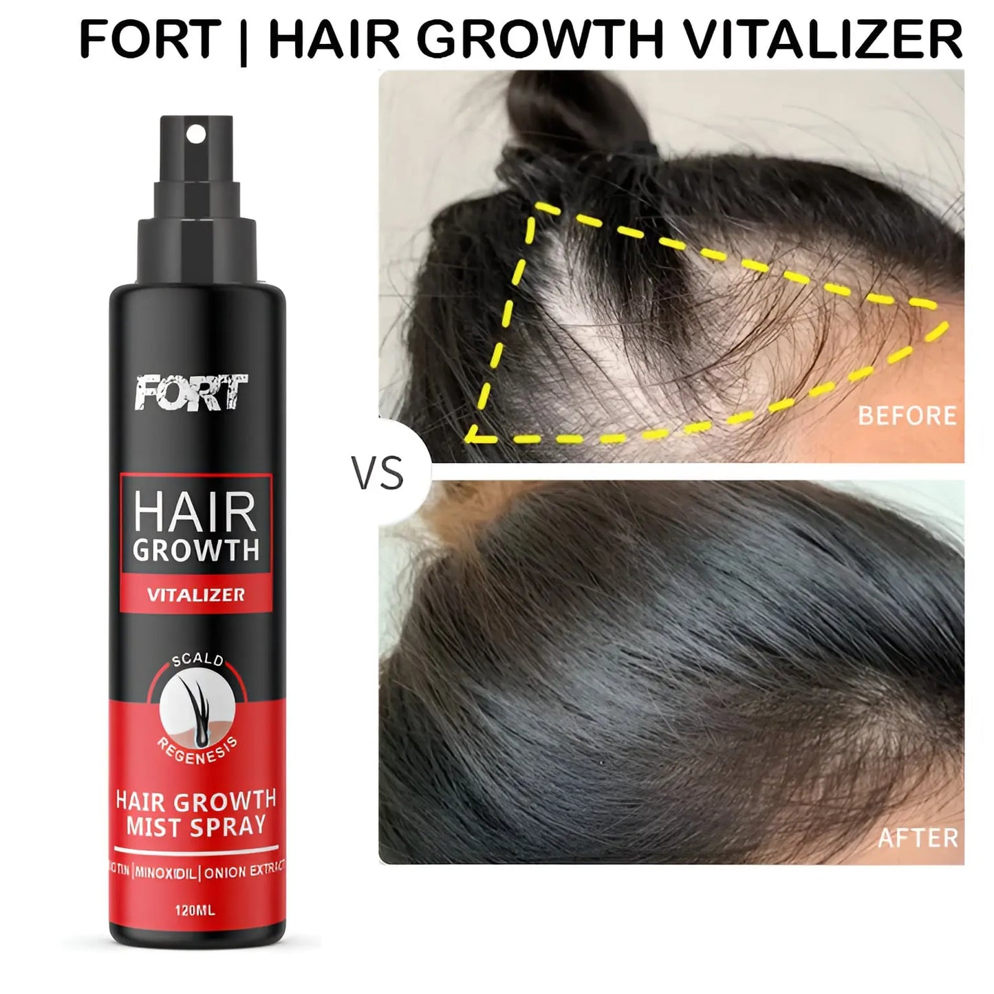 FORT Minoxidil Hair Growth Spray