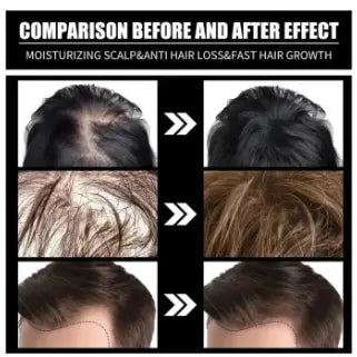 FORT Minoxidil Hair Growth Spray